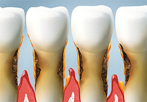 Burbank dentist |  gum disease treatment | Dr. Ananian