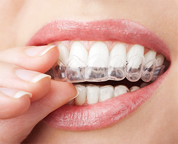 Burbank dentist | Invisalign clear braces | retainer | Dr Ananian